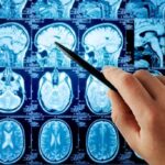 Rare Brain Disorder Sparks COVID Vaccine Debate A hand pointing at MRI brain scans displayed on a screen
